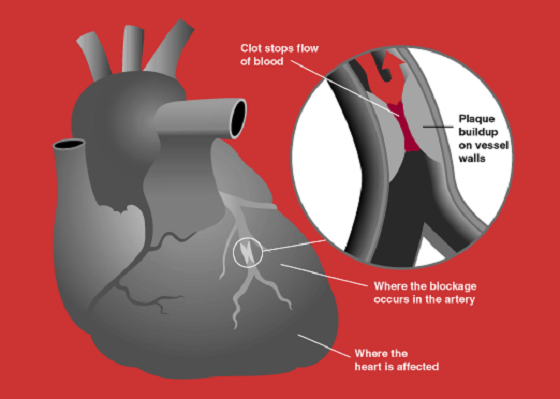 Por qué el colesterol alto produce infartos 