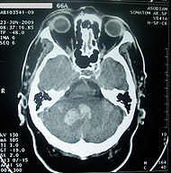 Causas Y Consecuencias De Un Accidente Cerebrovascular