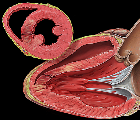 ¿Qué es una angina de pecho? 