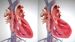 Fisiopatología de la insuficiencia cardíaca congestiva: síntomas y tratamiento en PDF