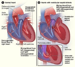 ¿Qué es una cardiopatia congénita?
