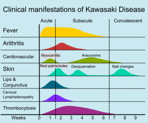 Enfermedad de kawasaki en niños y en adultos, síntomas y tratamiento